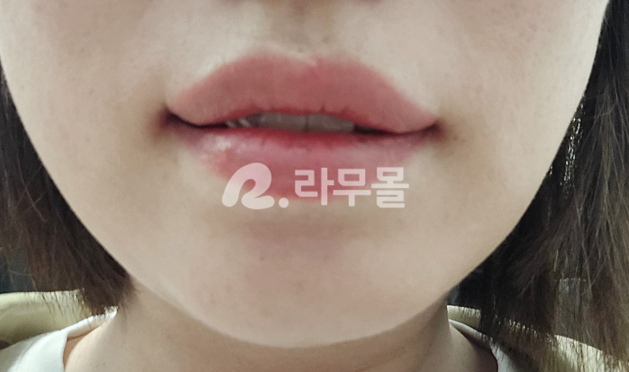 아큐파인  (이소트레티노인)20mg 직구 후기